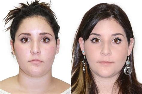 Face Asymmetry And Bite Correction Surgery Case Corrective Jaw
