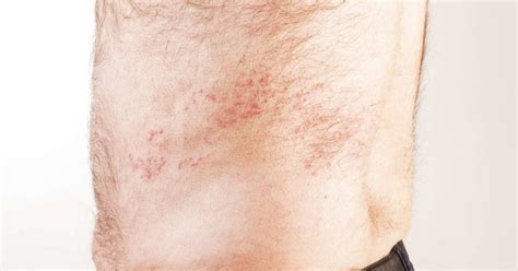 Is It Shingles Symptoms Vs Other Conditions And Causes