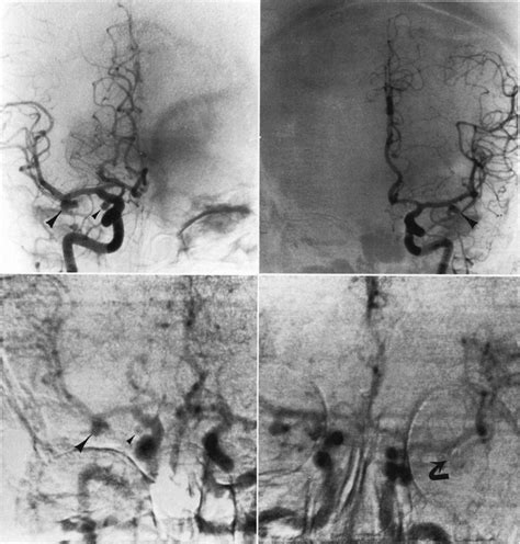 Digital Video Subtraction Angiography Of The Cervical And Cerebral