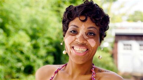 Black And White Skin Body Positive Mum Owns Her Vitiligo Condition