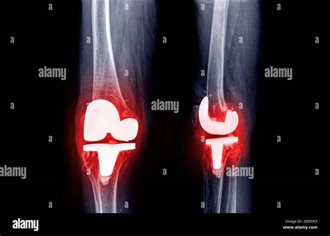 Film X Ray Knee Ap And Lateral View Of Osteoarthritis Knee Patient And