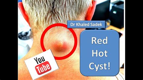 I Want To Break Free Cyst LipomaCyst Com Dr Khaled Sadek YouTube