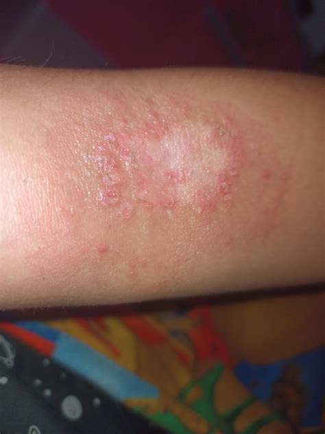 Is This A Ringworm Ive Had It For 2 Weeks Now And Its Very Itchy R