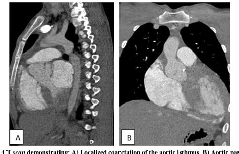 Figure 1 From Aorto Mitral Discontinuity Caused By Infectious