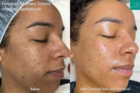 Saltfacial Skin Renewal Therapy San Diego Ca Clderm