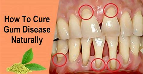 How To Cure Gum Disease Naturally