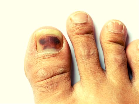 Collection Of Skin Cancer Under Toenail Pictures Of Toenail Colors