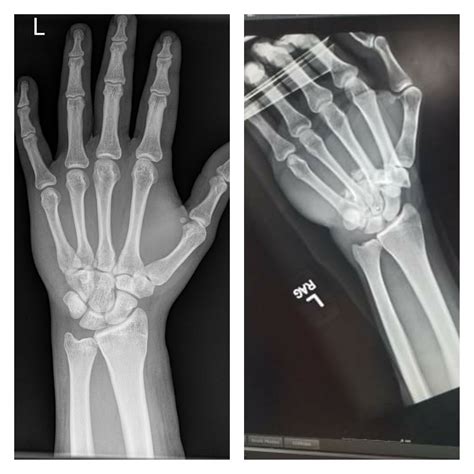 What A Normal Hand X Ray Looks Like Left And What I