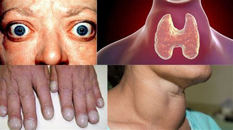 Graves Disease Symptoms Causes Treatment And Role Of Hyperthyroidism