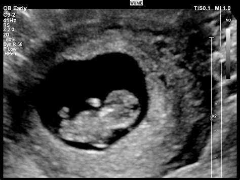 Us Obstetric Nuchal Dating Scan Meaning Nuchal Scan Ultrasound Scans