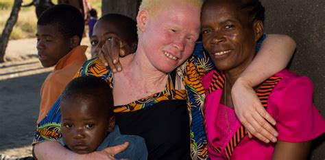 5 Facts About Albinism In Malawi Amnesty International