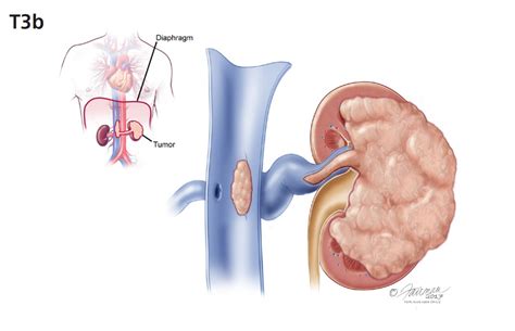 Kidney Cancer Symptoms Diagnosis And Treatment Urology Care Foundation
