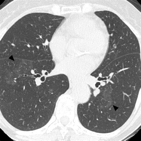 Figure1high Resolution Computed Tomography Of The Lungs Shows