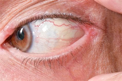 Conjunctival Retention Cysts Stock Image C0426382 Science Photo