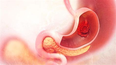 Toda la información sobre las causas, los síntomas, tratamientos, tipos, diagnóstico. ¿Qué es el cáncer de estómago? | Síntomas, causas y cómo ...