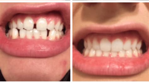 Before And After So Pleased With The Results Invisalign