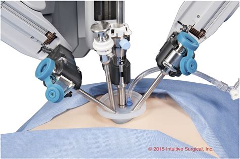 Robotic Assisted Single Site Cholecystectomy In Children Journal Of