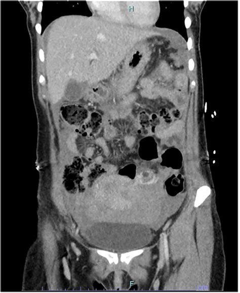 Ct Scan Of The Abdomen Showing Free Fluid In The Pelvis And Upper