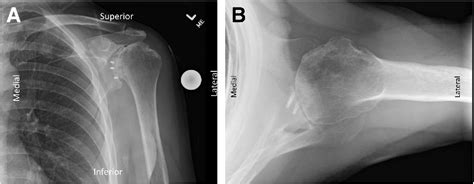 Figure 1 From Subscapularis Repair Prior To Subscapularis Takedown In