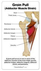 Since their muscle mass is not located in the pelvic area, but on the thigh, they are. Groin Strain - Volleyball.Com