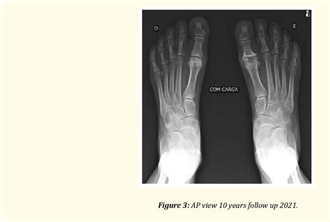 Figure 1 From Years Follow Up Of Cartiva Implant For Hallux Rigidus