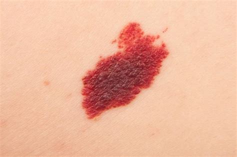 Birthmarks Red As Related To Keratosis Pictures