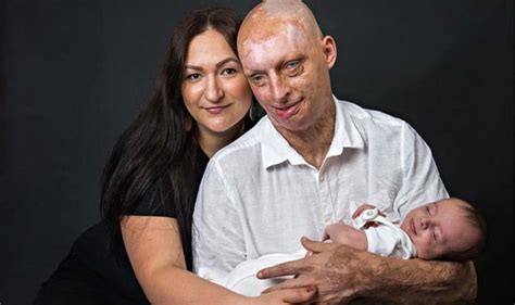 Acid Attack Victim Who Was Blinded Finds Love With His Carer And Becomes A Father Uk News