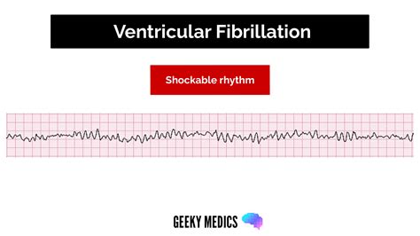 Shockable Vs Non Shockable Rhythms In Cardiac Arrest Geeky Medics