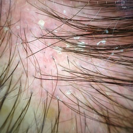 Below are possible treatments that. Seborrheic Dermatitis: What Is It, Diagnosis & Treatment