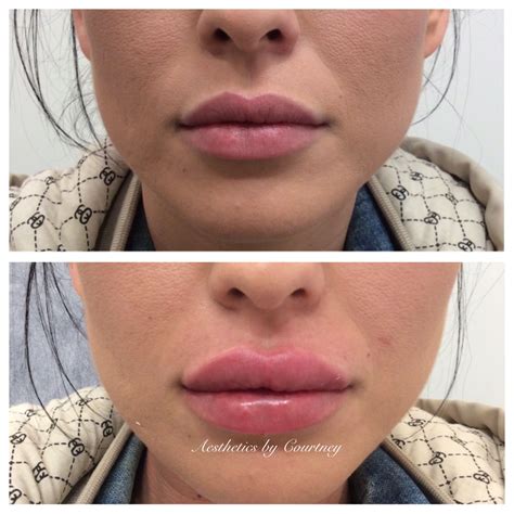 Cosmetic Or Plastic Surgery Skin Care Info Lip Injections Lip
