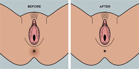 Pictures Showing For Before And After Anal Mypornarchive Net