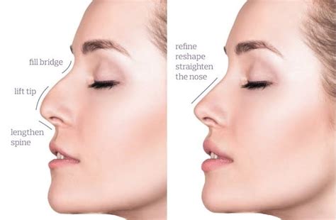 5 Reasons To Try The Hiko Nose Thread Lift With Dr Ros Dr Ros