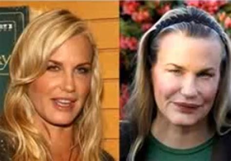 Celebrity Before And After Plastic Surgery Disasters