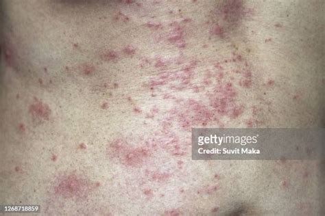 Hives Rash Photos And Premium High Res Pictures Getty Images