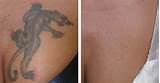 Side Effects Of Tattoo Removal By Laser Pictures
