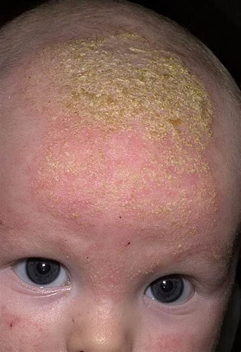 Seborrheic Dermatitis In Child Pictures Symptoms And Pictures