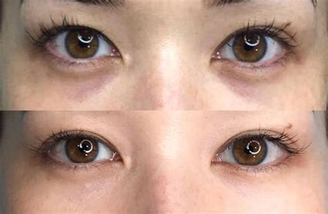 Permanent Under Eye Concealer Tattoo Its Now A Thing