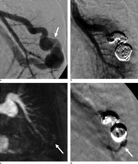 Reperfusion Rates Of Pulmonary Arteriovenous Malformations After Coil