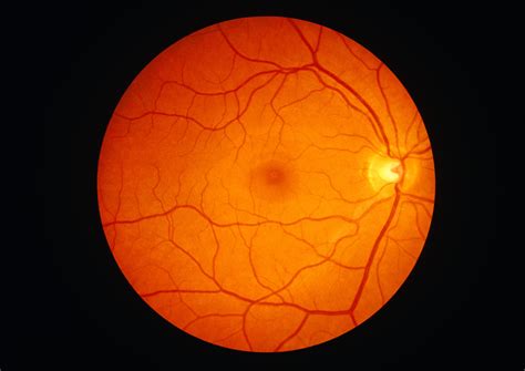 Retinal Detachment Symptoms Causes Diagnosis And Treatment