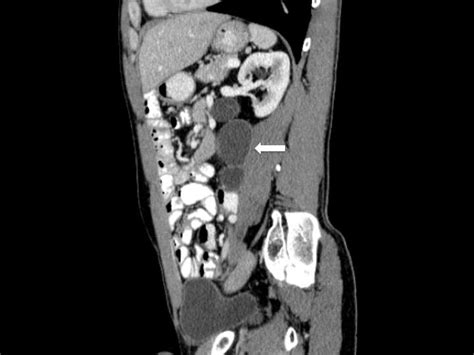 Mpr Of The Ct Enhanced Showing The Same Patient With Cystic