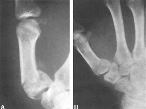 Thumb Fractures