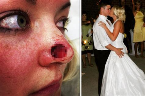 Woman With Skin Cancer From Sunbeds Has Huge Hole Cut Out Of Nose