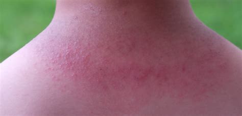 Heat Rash Symptoms Causes Treatment Preventions All You Need To Know