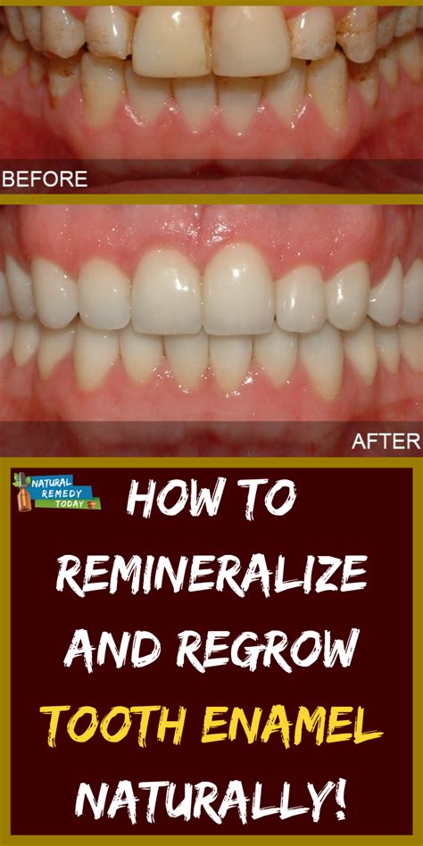 How To Remineralize Teeth Enamel Sho News