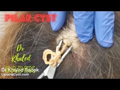 Pilar Cyst Removal London Dr Khaled Sadek Lipomacyst Com Youtube