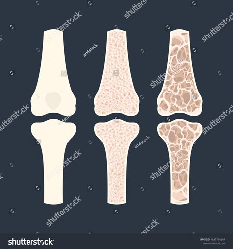 Osteoporosis Disease Stages Bone Density Loss Stock Vector Royalty