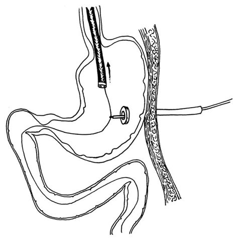 Percutaneous Endoscopic Gastrostomy Peg A Practical