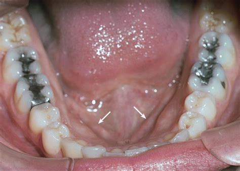 Photos Of Oral Cancer On Floor Of Mouth