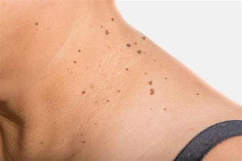 Skin Tags Verrucas And Warts Treatments In Bradford