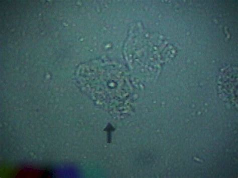 Bacterial Vaginosis Bv